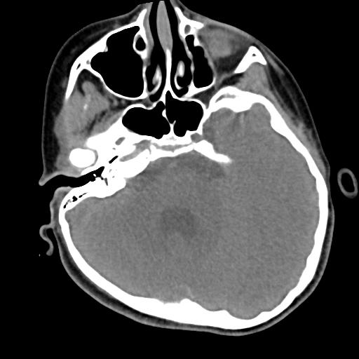 Chiari I with syrinx and skull base anomalies (Radiopaedia 89444-106412 Axial non-contrast 15).jpg