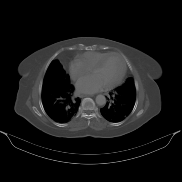 Cholangiocarcinoma (Radiopaedia 50592-56025 Axial bone window 3).jpg