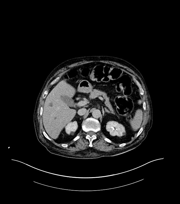 Cholangiocarcinoma with cerebral metastases (Radiopaedia 83519-98629 Axial C+ delayed 32).jpg