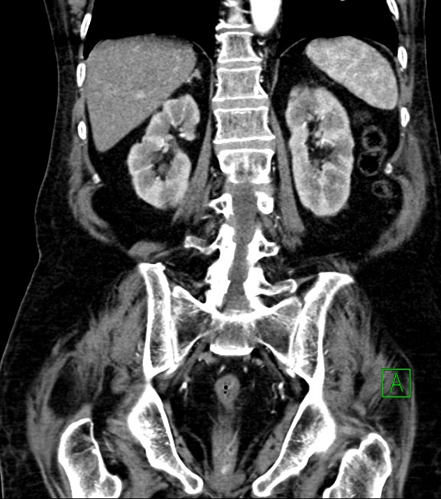Cholangiocarcinoma with cerebral metastases (Radiopaedia 83519-98629 E 62).jpg