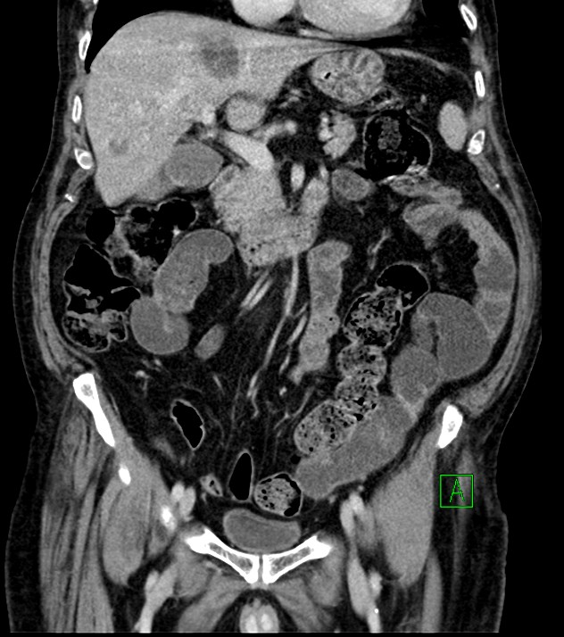 Cholangiocarcinoma with cerebral metastases (Radiopaedia 83519-98629 G 36).jpg