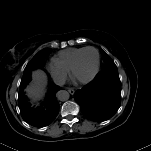 File:Cholecystitis - obstructive choledocholitiasis (CT intravenous cholangiography) (Radiopaedia 43966-47479 Axial 135).png