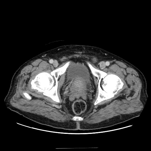 Choledocholiathiasis with normal caliber common bile duct (Radiopaedia 75368-86632 A 183).jpg