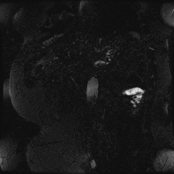 Choledocholithiasis on CT and MRI (Radiopaedia 24825-25088 Coronal T2 109).jpg