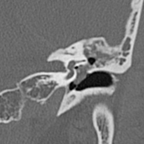 File:Cholesteatoma (Radiopaedia 9408-10093 Coronal bone window 7).jpg