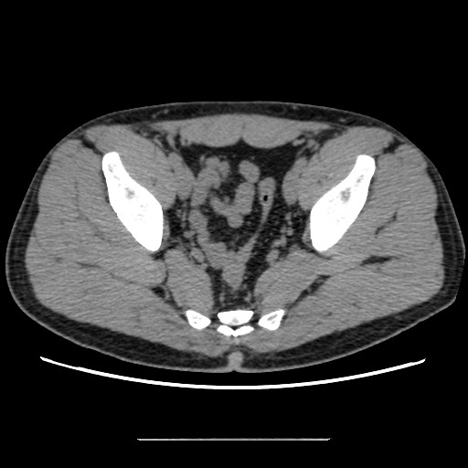 Chondrosarcoma of iliac wing (Radiopaedia 63861-72599 Axial non-contrast 82).jpg