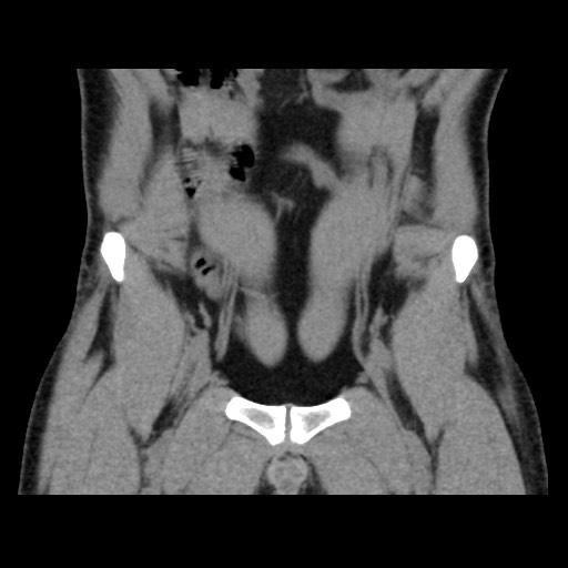 Chondrosarcoma of iliac wing (Radiopaedia 63861-72599 Coronal non-contrast 32).jpg