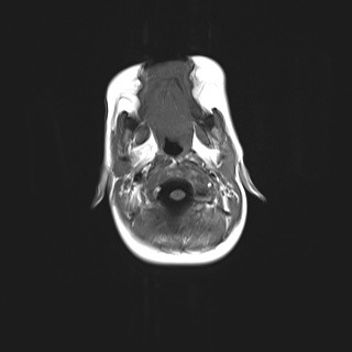 File:Choroid plexus papilloma (Radiopaedia 84612-100019 Axial T1 2).jpg