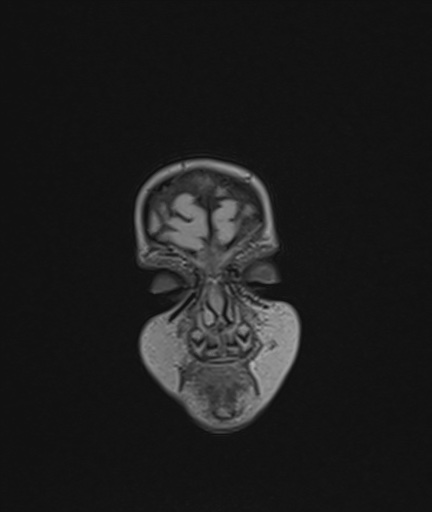 Choroid plexus papilloma (Radiopaedia 84612-100019 Coronal FLAIR 3).jpg