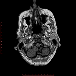 Choroid plexus xanthogranuloma (Radiopaedia 67843-77270 Axial T1 147).jpg