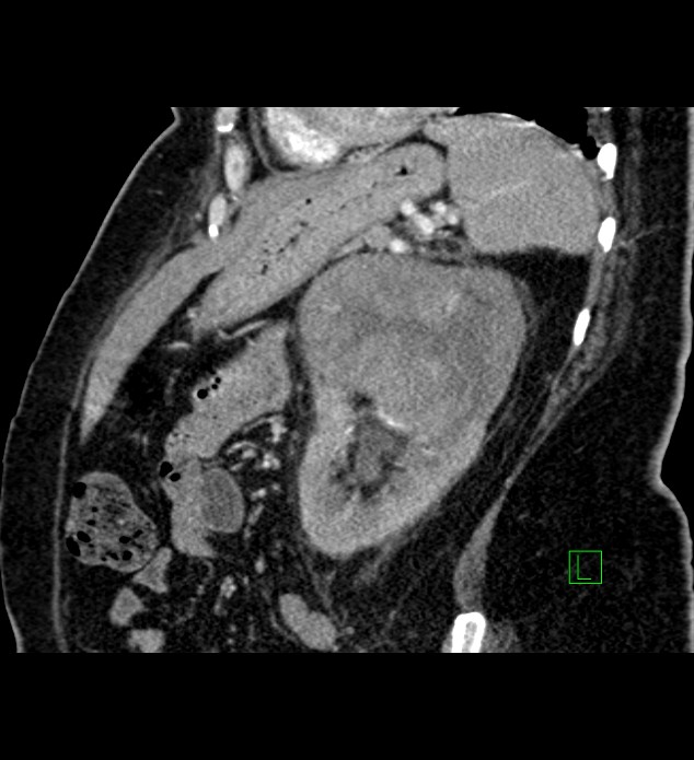 Chromophobe renal cell carcinoma (Radiopaedia 84239-99519 D 37).jpg