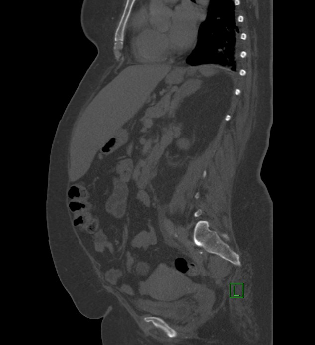 Chromophobe renal cell carcinoma (Radiopaedia 84239-99519 Sagittal bone window 46).jpg