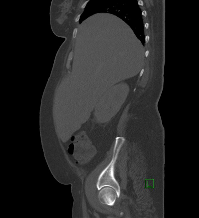 Chromophobe renal cell carcinoma (Radiopaedia 84239-99519 Sagittal bone window 84).jpg