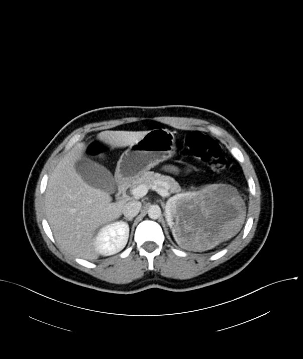 Chromophobe renal cell carcinoma (Radiopaedia 84255-99542 F 26).jpg