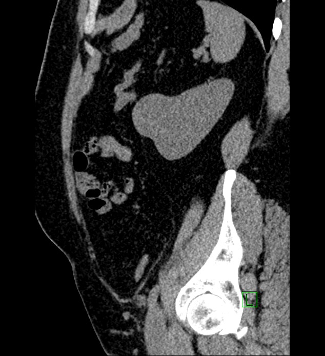 Chromophobe renal cell carcinoma (Radiopaedia 84286-99573 C 40).jpg