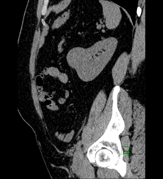 Chromophobe renal cell carcinoma (Radiopaedia 84286-99573 C 43).jpg