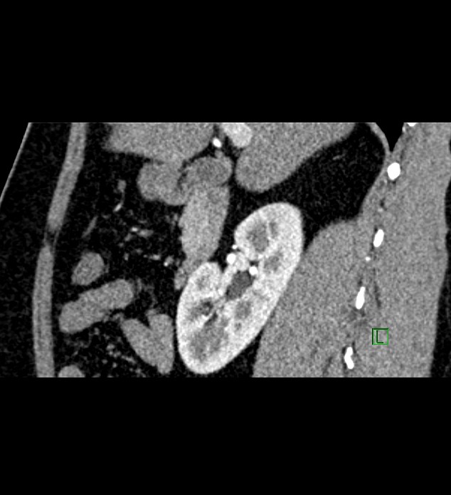 Chromophobe renal cell carcinoma (Radiopaedia 84286-99573 F 110).jpg