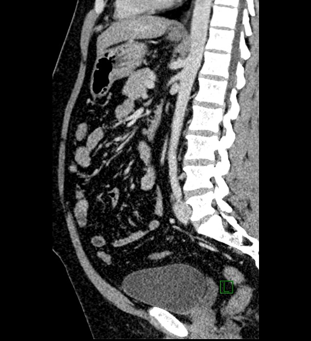 Chromophobe renal cell carcinoma (Radiopaedia 84286-99573 I 82).jpg
