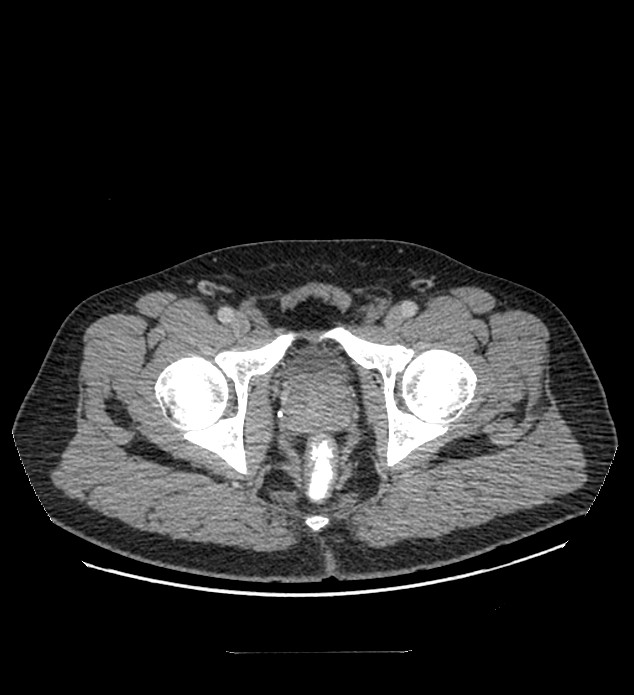 Chromophobe renal cell carcinoma (Radiopaedia 84337-99644 C 130).jpg