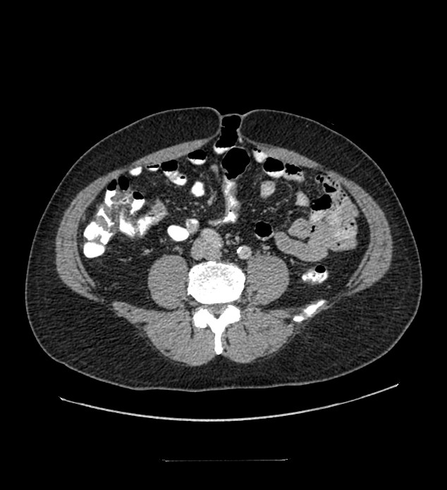 Chromophobe renal cell carcinoma (Radiopaedia 84337-99644 C 83).jpg