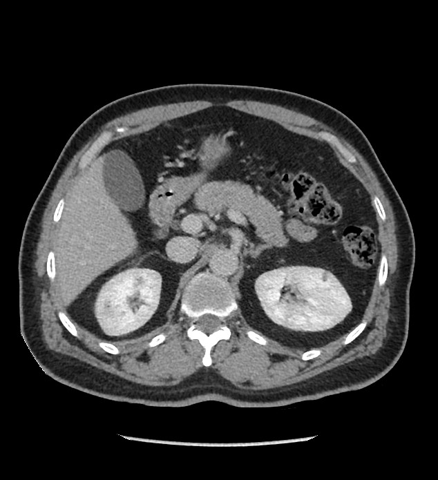 Chromophobe renal cell carcinoma (Radiopaedia 86879-103083 C 45).jpg