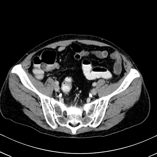 Chronic appendicitis complicated by appendicular abscess, pylephlebitis and liver abscess (Radiopaedia 54483-60700 B 114).jpg