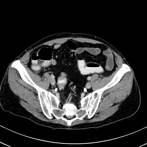 Chronic appendicitis complicated by appendicular abscess, pylephlebitis and liver abscess (Radiopaedia 54483-60700 B 115).jpg