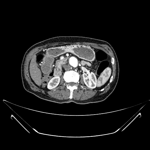Chronic contained rupture of abdominal aortic aneurysm with extensive erosion of the vertebral bodies (Radiopaedia 55450-61901 A 19).jpg