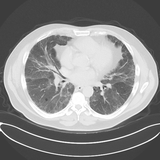 Chronic hypersensitivity pneumonitis (Radiopaedia 48107-52922 Axial lung window 35).png