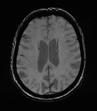 Chronic hypertensive encephalopathy (Radiopaedia 39993-42482 Axial SWI 58).png