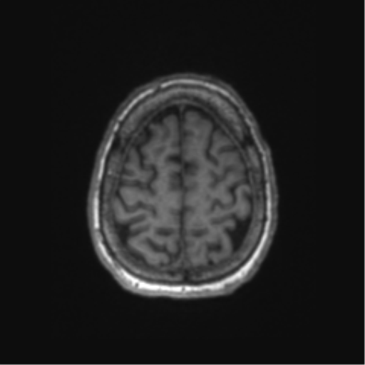 File:Chronic hypertensive encephalopathy (Radiopaedia 72844-83495 Axial T1 14).png