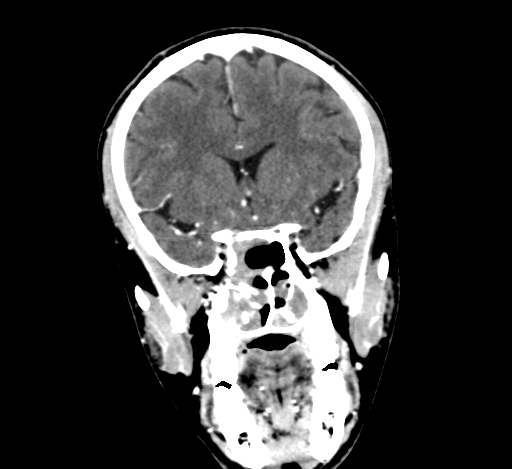 Chronic invasive fungal sinusitis with intraorbital and intracranial extension (Radiopaedia 56387-63046 C 151).jpg