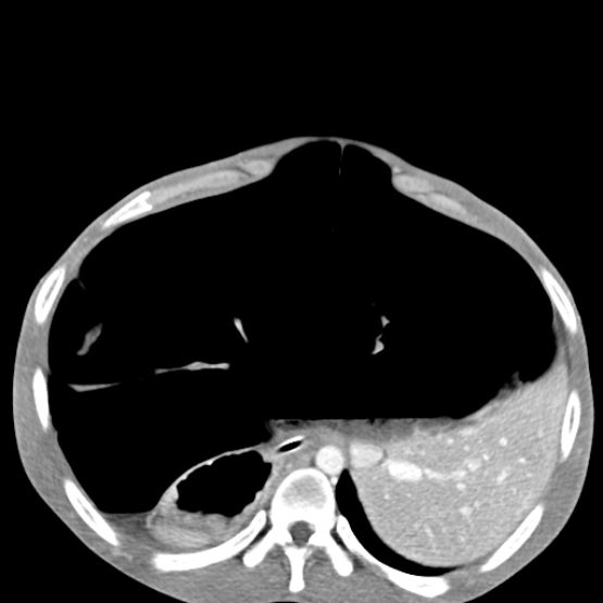 Chronic large bowel pseudo-obstruction (Radiopaedia 43181-46492 A 47).jpg