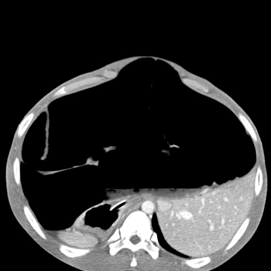 Chronic large bowel pseudo-obstruction (Radiopaedia 43181-46492 A 49).jpg