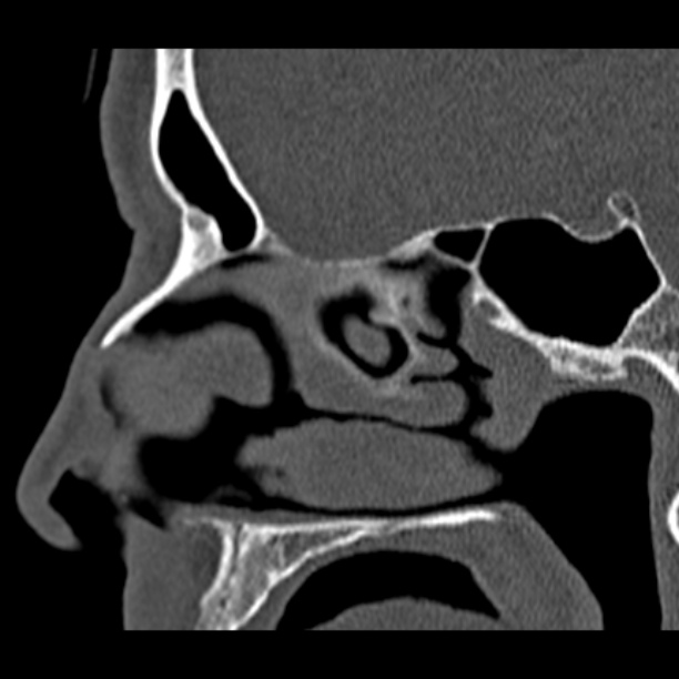 Chronic maxillary sinusitis (Radiopaedia 27879-28116 Sagittal bone window 25).jpg