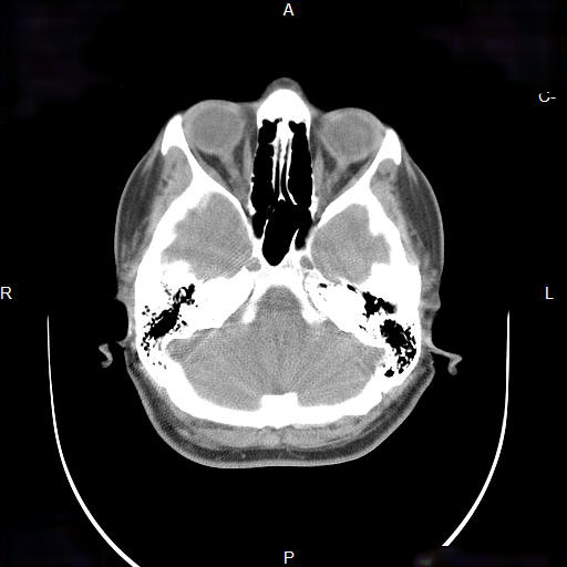 File:Chronic maxillary sinusitis with a foreign body (dental filling material) (Radiopaedia 7811-8639 Axial non-contrast 9).jpg