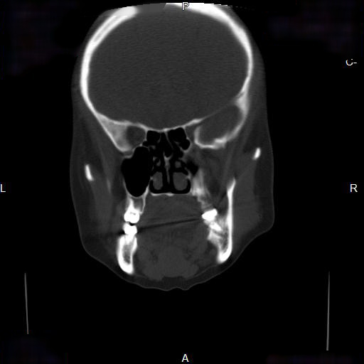 File:Chronic maxillary sinusitis with a foreign body (dental filling material) (Radiopaedia 7811-8639 Coronal bone window 9).jpg