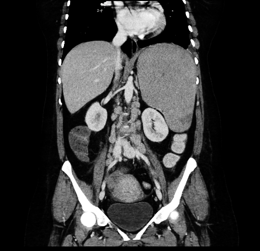 File:Chronic myeloid leukemia with splenic infarction (Radiopaedia 9178-9874 A 1).jpg