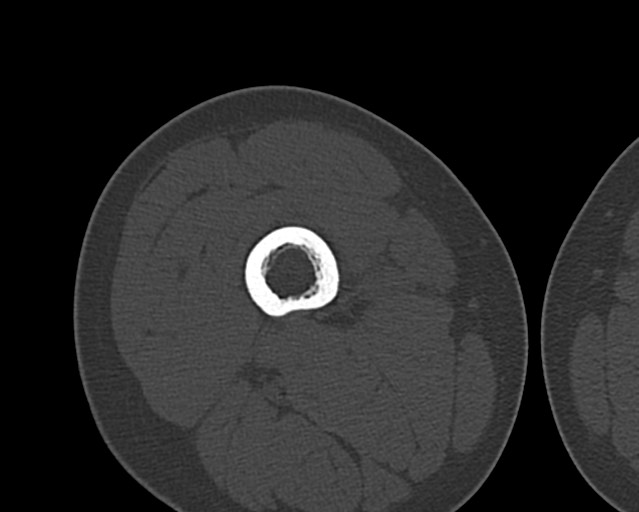 Chronic ostemyelitis of the femur with long sinus tract (Radiopaedia 74947-85982 Axial bone window 84).jpg