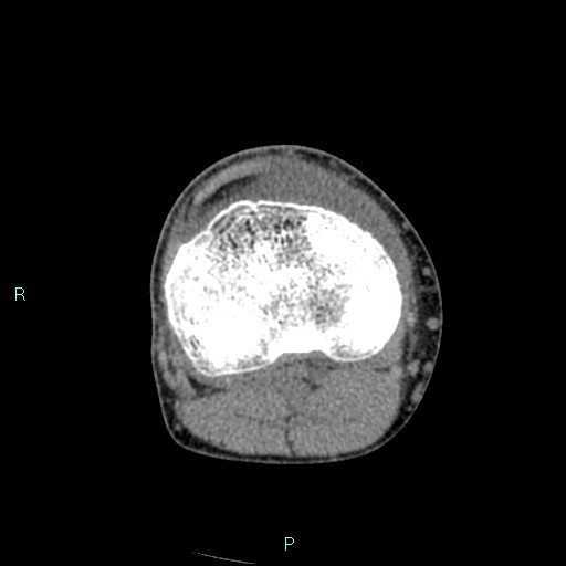 Chronic osteomyelitis (with Brodie abscess) (Radiopaedia 76405-88111 A 100).jpg