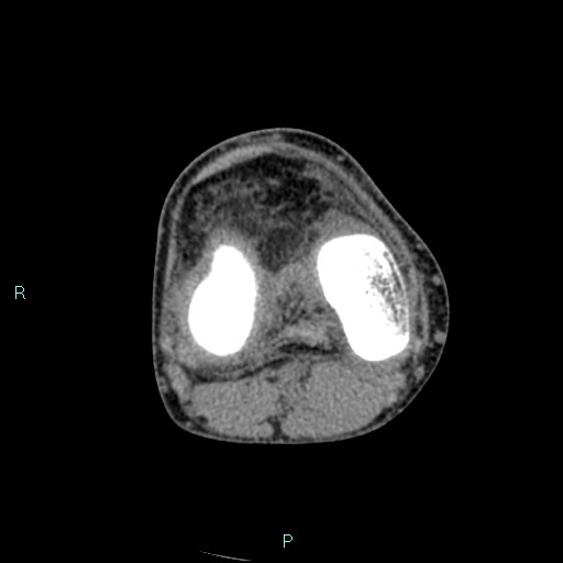 File:Chronic osteomyelitis (with Brodie abscess) (Radiopaedia 76405-88111 A 115).jpg
