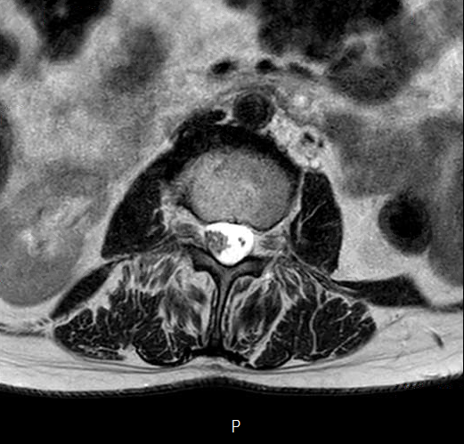 File:Chronic spinal hematoma with cauda equina syndrome (Radiopaedia 75745-87090 Axial T2 2).png
