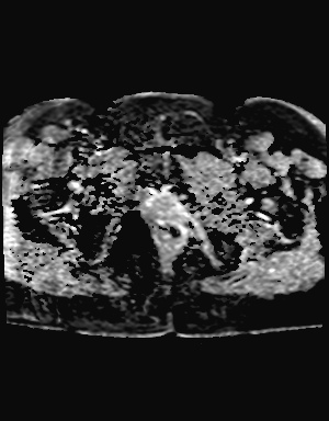 File:Class II Mullerian duct anomaly- unicornuate uterus with rudimentary horn and non-communicating cavity (Radiopaedia 39441-41755 Axial ADC 26).jpg