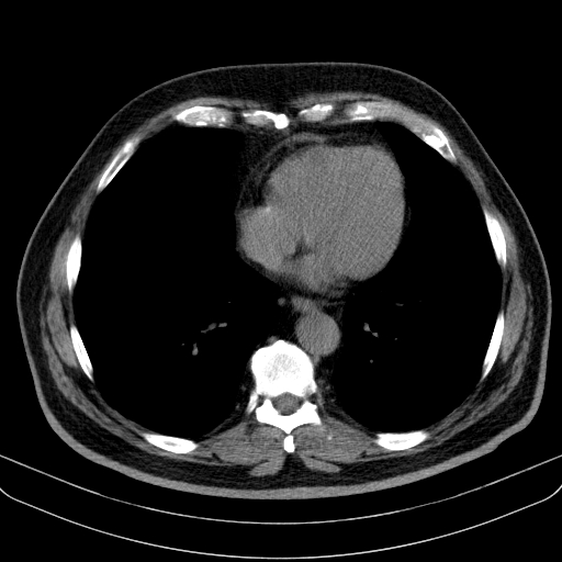 File:Classic complicated silicosis (Radiopaedia 49720-54961 Axial liver window 38).jpg