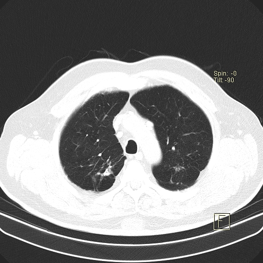 File:Classic complicated silicosis (Radiopaedia 49720-54961 Axial lung window 13).jpg