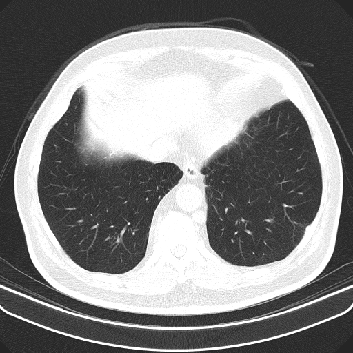 File:Classic complicated silicosis (Radiopaedia 49720-54961 Axial lung window 47).jpg