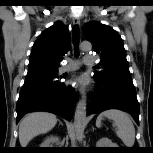 File:Classic complicated silicosis (Radiopaedia 49720-54961 Coronal liver window 34).jpg