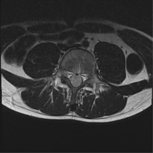 File:Clear cell meningoma - lumbar spine (Radiopaedia 60116-67690 Axial T2 15).png