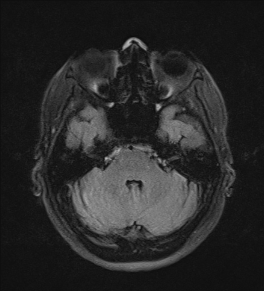 File:Clival meningioma (Radiopaedia 53278-59248 Axial FLAIR 6).jpg