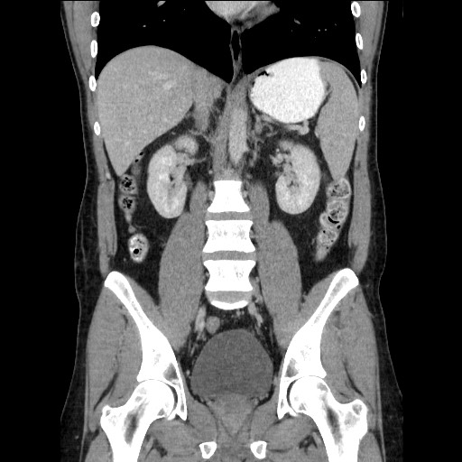 Closed-loop small bowel obstruction (Radiopaedia 73713-84509 C 73).jpg